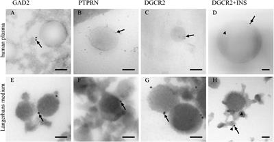 Extracellular Vesicles Derived Human-miRNAs Modulate the Immune System in Type 1 Diabetes